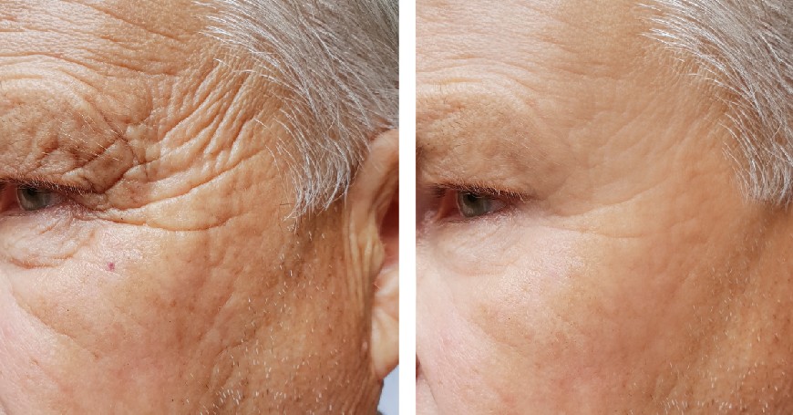 filler-viso-risultati-prima-e-dopo filler-viso-risultati-prima-e-dopo